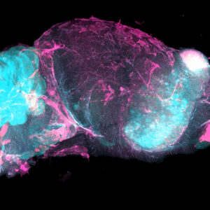 Intact mouse brain hemisphere with large tumor in the striatum, stained with SYTO16 and lectin, imaged with SmartSPIM