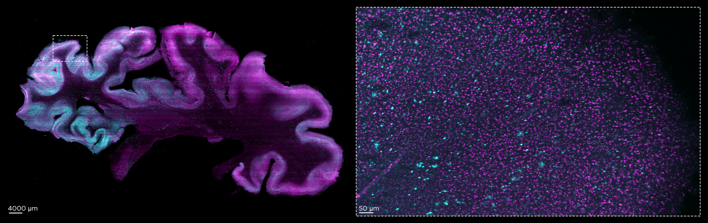 Human brain sample stained with phospho-tau and alpha-synuclein